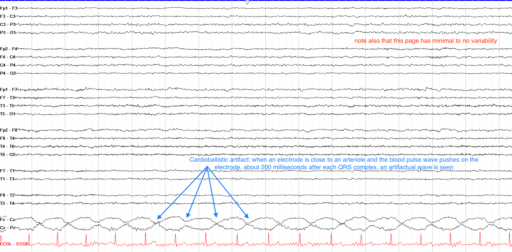 cardioballistic artifact ：由于电极被放在了动脉正上面导致的