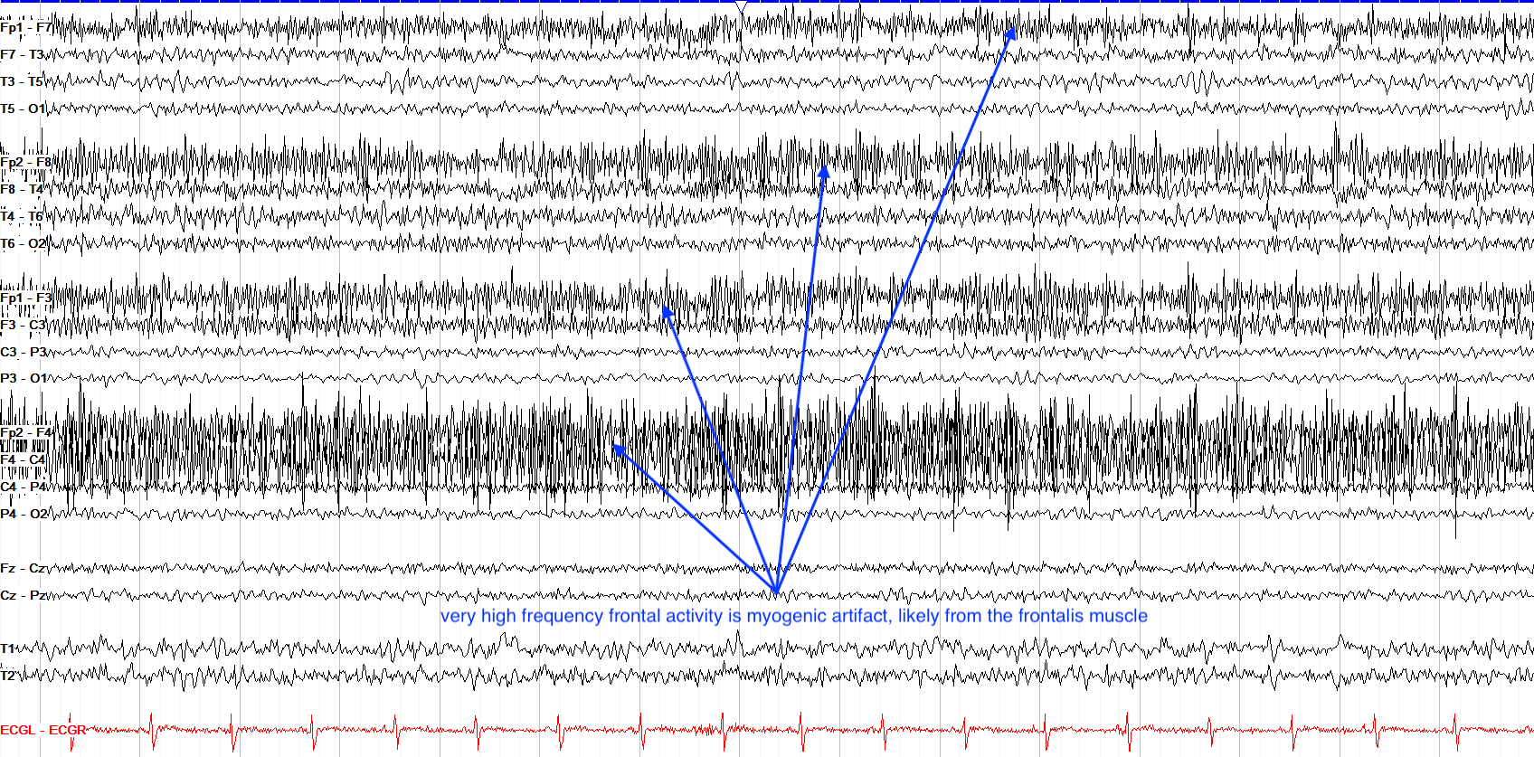 Myogenic artifact：20-40Hz的高频高幅值运动，常见于frontal 或 lateral temporal regions，可以通过ICA去除