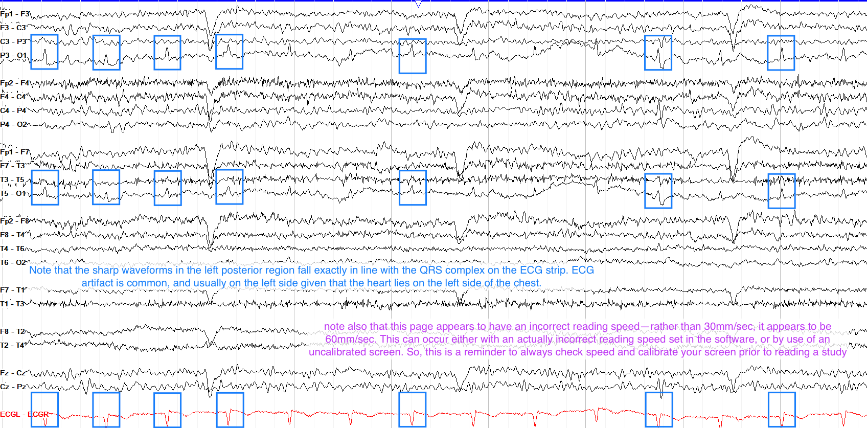 心脏伪影ECG artifact：通常和心电图重合，但可能由于读入速度不同而不完全重合。多出现在左侧的电极上