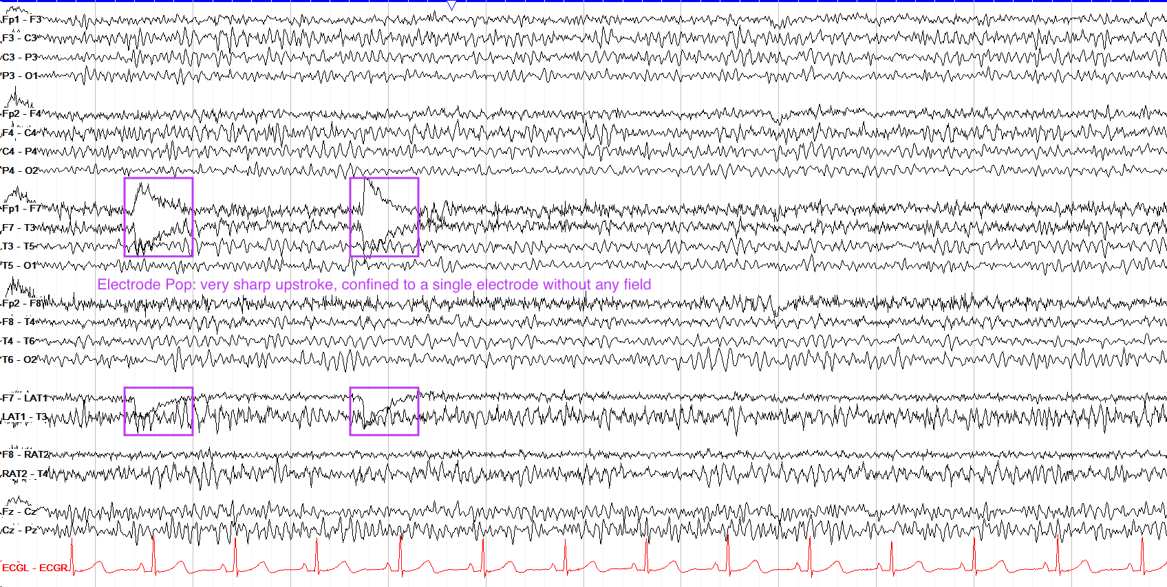 Electrode Pop: Often caused by a loose electrode, characterized by a steep rise and slow fall.