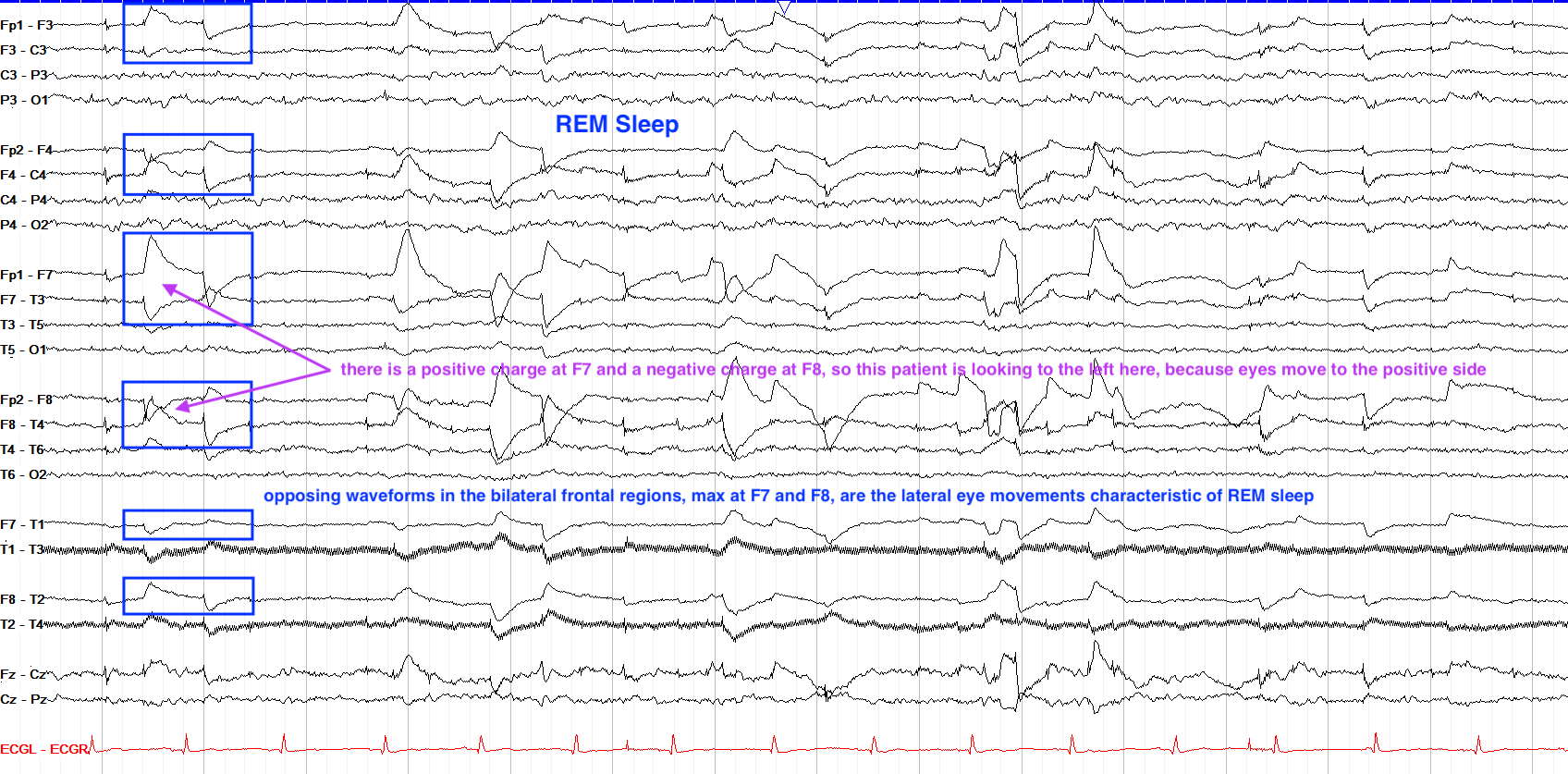 Eye Movement: Indicated by a positive spike in F7, a negative spike in F8, and relative fluctuations in other electrode areas like F3 and F4. Can be addressed using fixation points, EOG electrodes, eye trackers, or spatial filtering (Surface Laplacian).