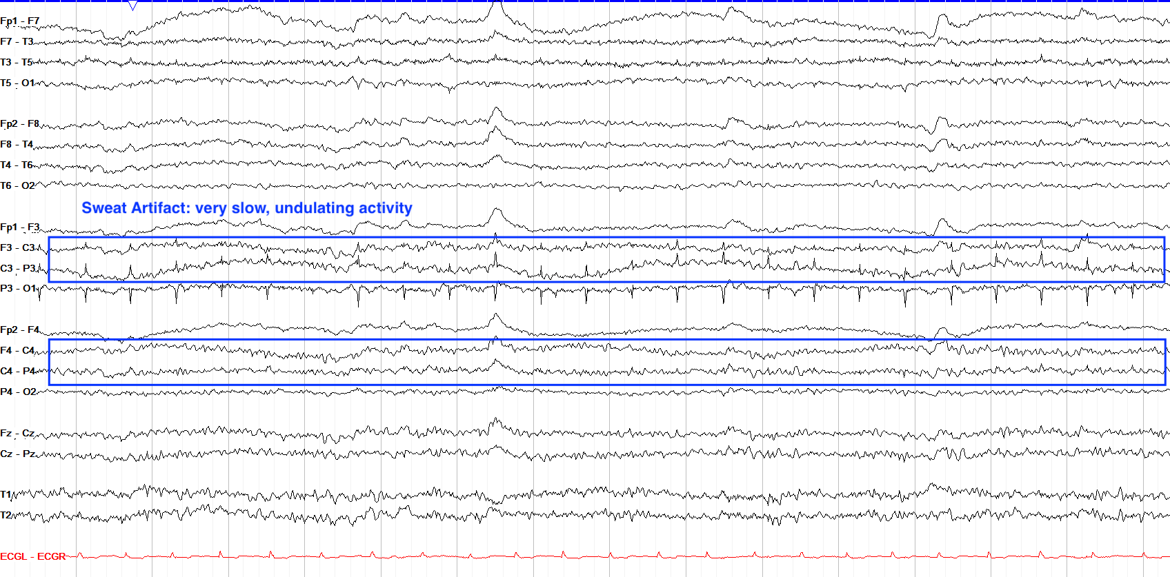 Sweat Artifact: Characterized by low-frequency wavy motion.