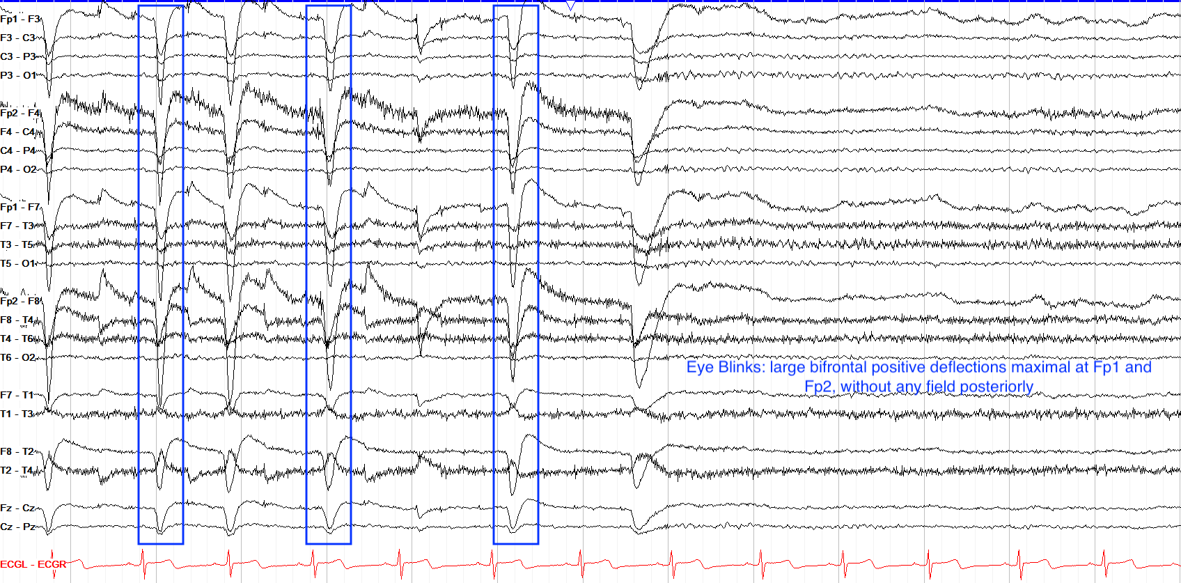 Eye Blinking: Identified by large negative waves in bifrontal regions (Fp). Can be removed using ICA.